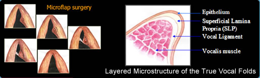 microflap-surgery